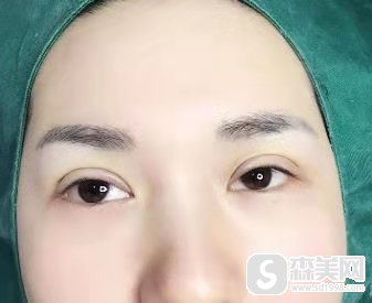 纳米微创双眼皮是长期的吗？怎么做？果展示