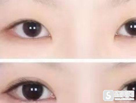 纳米微创双眼皮是长期的吗？怎么做？果展示