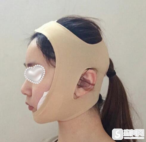 田凯月医生颌骨畸形矫正案例,技术如何?真实案例分享