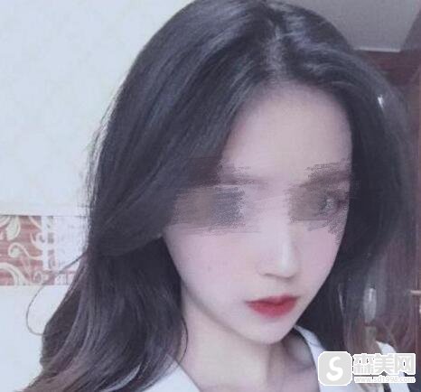 田凯月医生颌骨畸形矫正案例,技术如何?真实案例分享