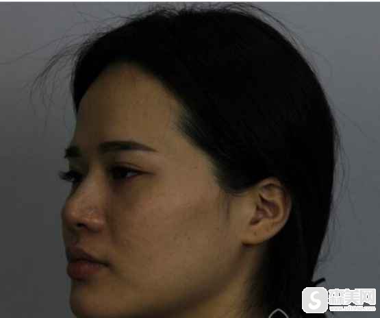 【祛斑日记】激光美肤去除斑点的10天的变化照片?推荐医院介绍,附前后对比图