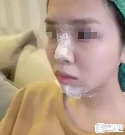 爱贝芙是长期性的吗?附案例展示以及术后果图