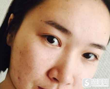 爱贝芙是长期性的吗?附案例展示以及术后果图