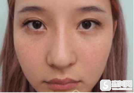 安徽医科大学第一附属医院的口碑如何?主要医生团队有谁?_赵宇医生_案例_鼻部整形
