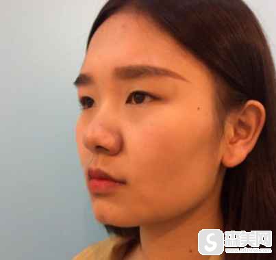 注射瘦脸注射瘦脸和国产瘦脸注射瘦脸的区别在哪?附两种注射瘦脸案例和果图