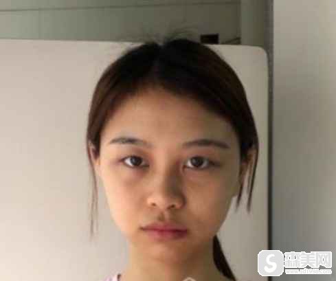 北京大学国际医院的口碑如何?_彭喆医生_案例分享_双眼皮手术