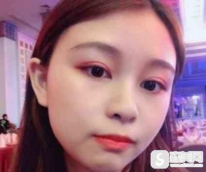 北京大学国际医院的口碑如何?_彭喆医生_案例分享_双眼皮手术