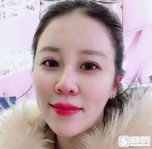 八大处祁佐良做的下颌角手术怎么样?附术前术后果对比图
