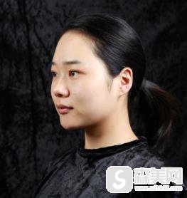 九院打玻尿酸隆鼻多少钱?附术后3个月恢复记录