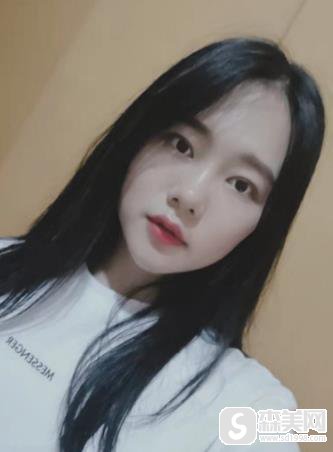 九院打玻尿酸隆鼻多少钱?附术后3个月恢复记录