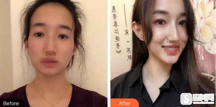 常州激光医院正不正规?双眼皮案例分享,附前后对比照片