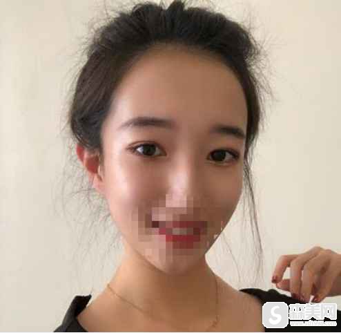 常州激光医院正不正规?双眼皮案例分享,附前后对比照片