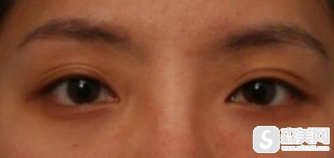 东莞华美做的网红风双眼皮,整个人是变得热烈又性感!附术后果图