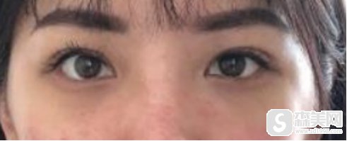 东莞华美做的网红风双眼皮,整个人是变得热烈又性感!附术后果图