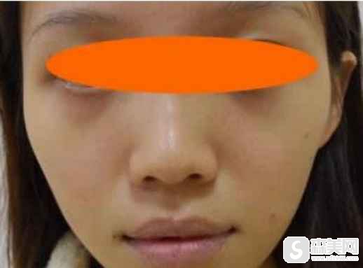 2021宁波美莱的价目表出炉,有较新较真实的案例分享,附术后图片