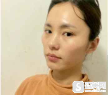 爱贝芙多少钱一支?什么是爱贝芙?附爱贝芙嫩肤实例及图片展示