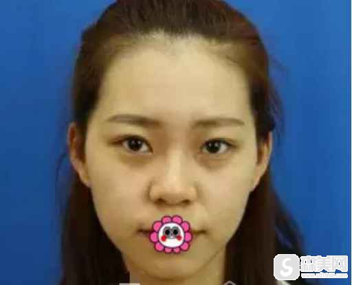 北京积水潭医院整形科怎么样?医生技术高吗?_案例_庞晓纲医生_双眼皮对比图