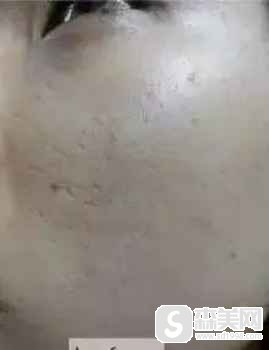 抗衰产品和丝丽水光补水哪个好?附两种水光补水前后对比图各一组