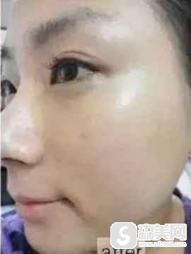 抗衰产品和丝丽水光补水哪个好?附两种水光补水前后对比图各一组