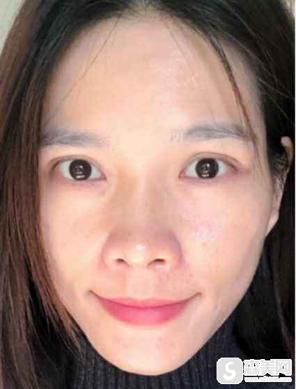 广空后勤整形医院的复合彩光嫩肤怎么样?附术后果图,推荐医生