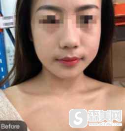 郝立君面部轮廓整形做的技术如何?附郝立君大夫介绍和真实案例图片