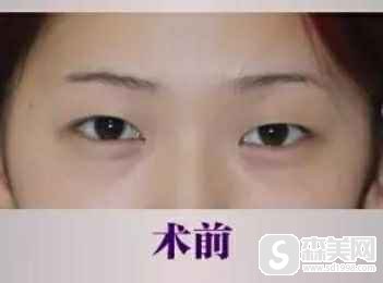 别惊讶!东莞知美整形医院的双眼皮，做完颜值就翻番了！附术后果图片