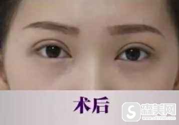 别惊讶!东莞知美整形医院的双眼皮，做完颜值就翻番了！附术后果图片