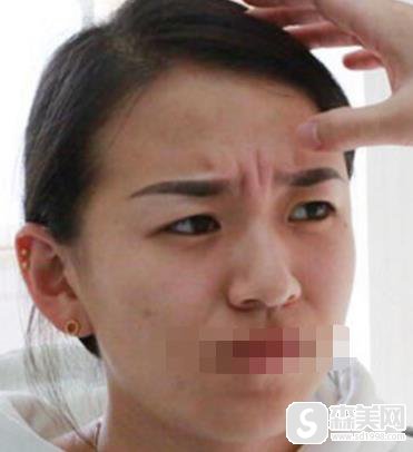 苏州圣爱像素射频除皱怎么样?真实案例恢复图对比