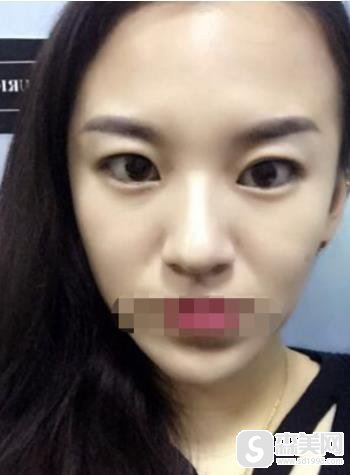 苏州圣爱像素射频除皱怎么样?真实案例恢复图对比