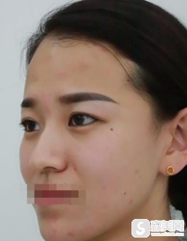 苏州圣爱像素射频除皱怎么样?真实案例恢复图对比
