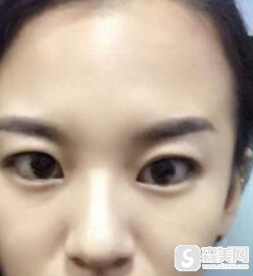 苏州圣爱像素射频除皱怎么样?真实案例恢复图对比