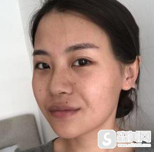 上海九院c8激光祛斑怎么样?前后对比图