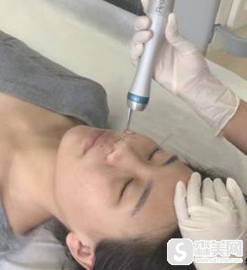 上海九院c8激光祛斑怎么样?前后对比图