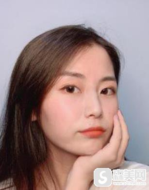 上海九院c8激光祛斑怎么样?前后对比图