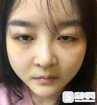 生物焊接双眼皮多少钱?浙二医院整形科恢复图对比