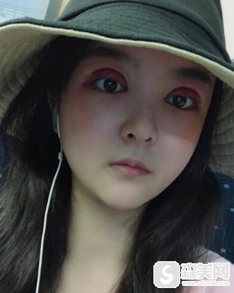 生物焊接双眼皮多少钱?浙二医院整形科恢复图对比