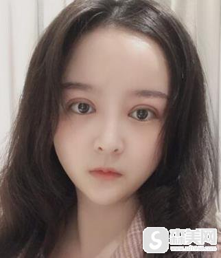 生物焊接双眼皮多少钱?浙二医院整形科恢复图对比