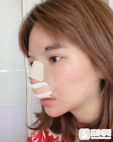 太原华美整形医院肋软骨隆鼻详情?整形科90天恢复一览