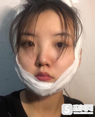 北京协和磨骨怎么样？手术对比照片