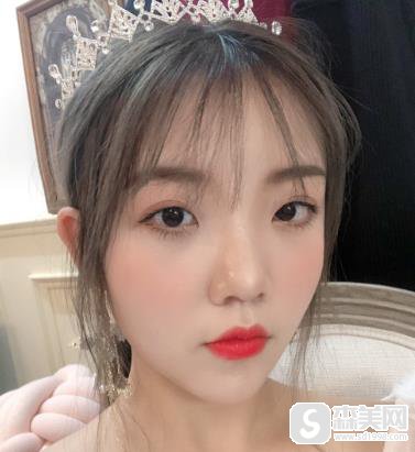 北京协和磨骨怎么样？手术对比照片