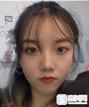 北京协和磨骨怎么样？手术对比照片