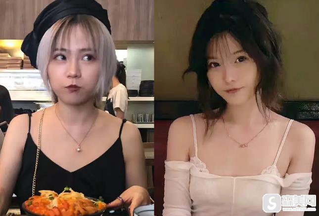 三甲医院有注射瘦肩吗?西京医院果图前后对比