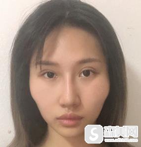 颧弓外扩怎么办?山西省整形科手术前后对比