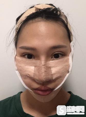 颧弓外扩怎么办?山西省整形科手术前后对比