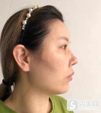 颧弓突出怎么办啊?手术前后对比图