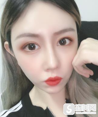 颧弓突出怎么办啊?手术前后对比图