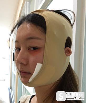 颧弓留白宽怎么改变？北京京民手术过程