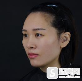 欧洲之星认证医生王晓璇案例?附手术前后对比