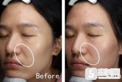 欧洲之星fotona售价贵不贵?上海九院恢复记录