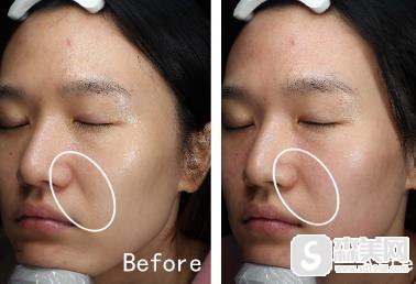 欧洲之星fotona售价贵不贵?上海九院恢复记录